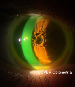 Imagen de la condición ocular vista de frente mediante iluminación difusa, tras previa instilación de fluoresceína.